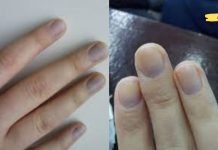 რატომ გვილურჯდება ფრჩხილები? მას რამე პრობლემა იწვევს? თუ ეს პრობლემა გაწუხებს აუცილებლად წაიკითე!!.