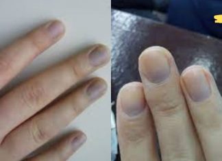 რატომ გვილურჯდება ფრჩხილები? მას რამე პრობლემა იწვევს? თუ ეს პრობლემა გაწუხებს აუცილებლად წაიკითე!!.