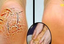 დედაჩემს აწუხებდა დამსკდარი ქუსლები. მან ამ მეთოდს მიმათა და დაისენა..