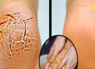 დედაჩემს აწუხებდა დამსკდარი ქუსლები. მან ამ მეთოდს მიმათა და დაისენა..