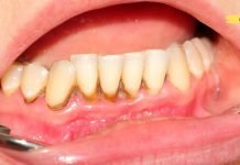 მოიშორეთ კბილებიდან ქვები სახლის პირობებში! ის ნამდვილად მუშაობს..