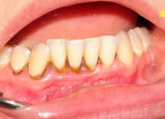 მოიშორეთ კბილებიდან ქვები სახლის პირობებში! ის ნამდვილად მუშაობს..