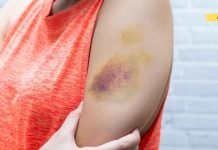 ყურადებით წაიკითხეთ! ეს სიმპტომები ლეიკემიას ახასიათებს,რომლებსაც ყურადღებას არ ვაქცევთ! არ უგულებელყოთ!