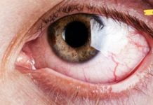 მოიშორეთ დაბინდული მხედველობა, თვალების წვა და გააუმჯობესეთ მხედველობა მარტივი ხელნაკეთი რეცეპტით!