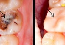 როგორ მოვიშოროთ კარიესი ბუნებრივად? იზრუნეთ თქვენს სტომატოლოგიურ ჯანმრთელობაზე!