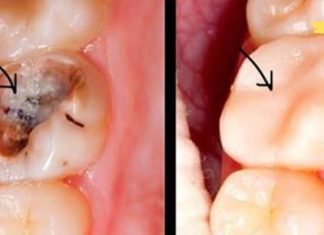 როგორ მოვიშოროთ კარიესი ბუნებრივად? იზრუნეთ თქვენს სტომატოლოგიურ ჯანმრთელობაზე!