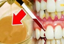 ეს 3 წვეთი ერთდროულად აშორებს კარიესს და მკურნალობს კბილებს. Ძალიან სასარგებლოა!