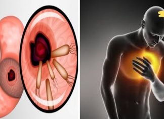 როგორ ავიცილოთ ბაქტერიები, რომლებიც იწვევენ გულძმარვას, შებერილობას და სხვა პრობლემებს. ვერასდროს ვიფიქრებდი. ეს უნდა იცოდე!