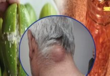 მოიცილეთ ლიპომები და კანის კისტები მხოლოდ ამ სახლის საშუალებით! მისი ეფექტიურობა დადასტურებულია