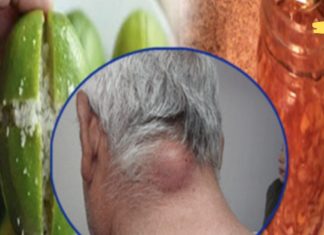 მოიცილეთ ლიპომები და კანის კისტები მხოლოდ ამ სახლის საშუალებით! მისი ეფექტიურობა დადასტურებულია