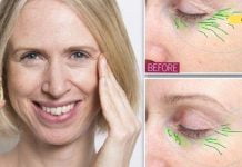 ამ პატარა ვიტამინს (კაფსულას) შეუძლია გაანადგუროს თვალების ქვეშ არსებული ნაოჭების და ჩანთების პრობლემები. შედეგით გაოცდებით!