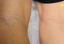 ეს ყველაზე მარტივად გამოსაყენებელი მეთოდია ვარიკოზული ვენების მოსაშორებლად! აი რა უნდა გააკეთოთ..