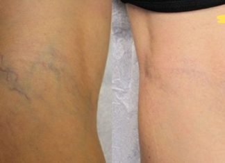 ეს ყველაზე მარტივად გამოსაყენებელი მეთოდია ვარიკოზული ვენების მოსაშორებლად! აი რა უნდა გააკეთოთ..