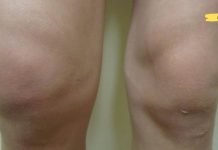 სითხე ჩაგიდგათ მუხლში? აქ არის ბუნებრივი და მარტივი გზა მის სწრაფად მოსაშორებლად! ეს მეთოდი მართლაც სწრაფად ხსნის ტკივილს!