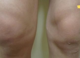 სითხე ჩაგიდგათ მუხლში? აქ არის ბუნებრივი და მარტივი გზა მის სწრაფად მოსაშორებლად! ეს მეთოდი მართლაც სწრაფად ხსნის ტკივილს!