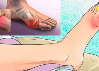 მოიშორეთ შარდმჟავა და სახსრების ტკივილი ამ მეთოდით! ამოიღოთ მარილები ორგანიზმიდან!