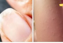 15 ნიშანი იმისა, რომ შეიძლება გქონდეთ რკინის დეფიციტი! რა უნდა გააკეთოთ ასეთ დროს!