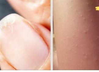 15 ნიშანი იმისა, რომ შეიძლება გქონდეთ რკინის დეფიციტი! რა უნდა გააკეთოთ ასეთ დროს!