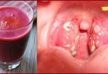 როგორ მოვიშოროთ ყელის ინფექციები სულ რაღაც 4 საათში. ეს აქამდე უნდა მცოდნოდა!