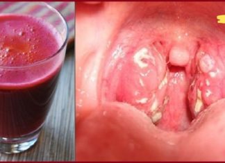 როგორ მოვიშოროთ ყელის ინფექციები სულ რაღაც 4 საათში. ეს აქამდე უნდა მცოდნოდა!