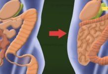 როგორ მოვიცილოთ მსხვილ ნაწლავში დაგროვილი 15 კგ ტოქსინები მხოლოდ 2 ინგრედიენტით? ცდად ღირს!