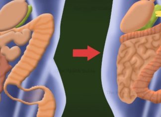 როგორ მოვიცილოთ მსხვილ ნაწლავში დაგროვილი 15 კგ ტოქსინები მხოლოდ 2 ინგრედიენტით? ცდად ღირს!