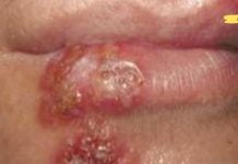 მოიშორეთ ჰერპესი ერთ დღეში! დადასტურებული მეთოდები..