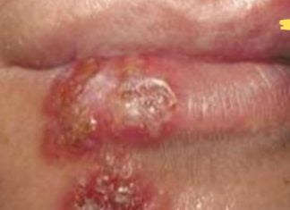 მოიშორეთ ჰერპესი ერთ დღეში! დადასტურებული მეთოდები..