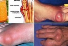 ეს ძლიერი ბუნებრივი სამკურნალო საშუალებაა პოდაგრის სამუდამოდ მოსაშორებლად! დაივიწყეთ ძვირადღირებული მაზები!