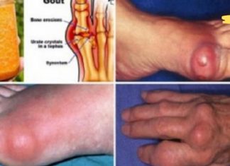 ეს ძლიერი ბუნებრივი სამკურნალო საშუალებაა პოდაგრის სამუდამოდ მოსაშორებლად! დაივიწყეთ ძვირადღირებული მაზები!