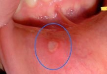 თუ პირის ღრუში მსგავს თეთრი ლაქას აღმოაჩენთ გამოიყენეთ ამ მეთოდებიდან რომელიმე. ამ საშინაო საშუალებებს შეუძლია სწრაფად გააქროს იგი!