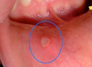 თუ პირის ღრუში მსგავს თეთრი ლაქას აღმოაჩენთ გამოიყენეთ ამ მეთოდებიდან რომელიმე. ამ საშინაო საშუალებებს შეუძლია სწრაფად გააქროს იგი!