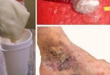 ამ ორი ინგრედიენტის შერევით თქვენ მიიღებთ ჯადოსნურ საშუალებას ვარიკოზული ვენებისა და თრომბოზის სამურნალოდ!