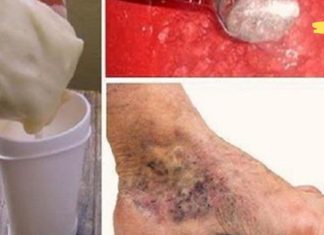 ამ ორი ინგრედიენტის შერევით თქვენ მიიღებთ ჯადოსნურ საშუალებას ვარიკოზული ვენებისა და თრომბოზის სამურნალოდ!