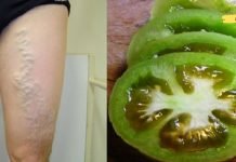 აი როგორ უნდა განვკურნოთ ვარიკოზული ვენები პომიდვრით! ეფექტური მეთოდია!