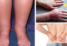 თუ თქვენი სხეული შეშუპებულია, ეს შეიძლება იყოს პროგრესული დაავადების ნიშანი!