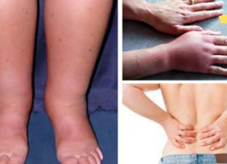 თუ თქვენი სხეული შეშუპებულია, ეს შეიძლება იყოს პროგრესული დაავადების ნიშანი!