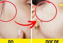 დაემშვიდობეთ სახის არასასურველ თმას ამ მარტივი ხელნაკეთი რეცეპტებით!