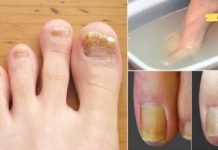 სამუდამოდ მოიშორეთ სოკო ამ 2 ინგრედიენტიანი რეცეპტით! ეს მართლა მუშაობს!