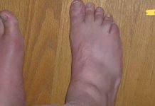 ამოიღეთ შარდმჟავას კრისტალები სახსრებიდან ამ 8 ბუნებრივი საშუალებებით