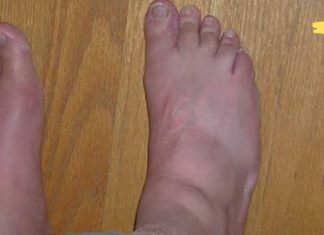 ამოიღეთ შარდმჟავას კრისტალები სახსრებიდან ამ 8 ბუნებრივი საშუალებებით