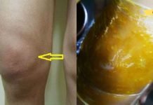 როგორ მოვიშოროთ სითხის დაგროვება და მუხლის ტკივილი ბუნებრივად! ტკივილი მყისიერად ქრება!