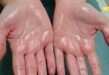 ოფლიანი ხელისგულები: როგორ მოვიშოროთ ეს პრობლემა? გაიგეთ მეტი ამის შესახებ..