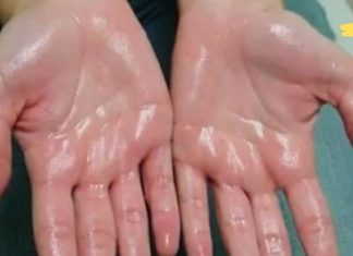 ოფლიანი ხელისგულები: როგორ მოვიშოროთ ეს პრობლემა? გაიგეთ მეტი ამის შესახებ..