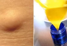 აი როგორ უნდა მოვიშოროთ ცხიმოვანი ქსოვილი (ლიპომა) ბუნებრივი გზით! ეს მეთოდი საკუთარ თავზე გამოვცადე!