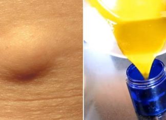 აი როგორ უნდა მოვიშოროთ ცხიმოვანი ქსოვილი (ლიპომა) ბუნებრივი გზით! ეს მეთოდი საკუთარ თავზე გამოვცადე!