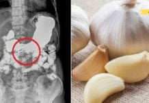 მიირთვით ნიორი ცარიელ კუჭზე ყოველდღიურად ტუბერკულოზის და ბრონქიტის სამკურნალოდ! წარმოუდგენლად სასარგებლო!