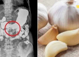 მიირთვით ნიორი ცარიელ კუჭზე ყოველდღიურად ტუბერკულოზის და ბრონქიტის სამკურნალოდ! წარმოუდგენლად სასარგებლო!