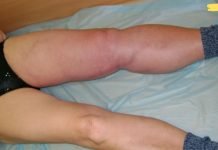 8 ნიშანი იმისა, რომ შესაძლოა სისხლის შედედება გქონდეთ. ყურადღებით გაეცანით ნიშნებს!