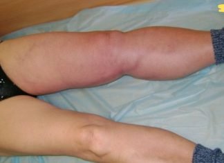 8 ნიშანი იმისა, რომ შესაძლოა სისხლის შედედება გქონდეთ. ყურადღებით გაეცანით ნიშნებს!